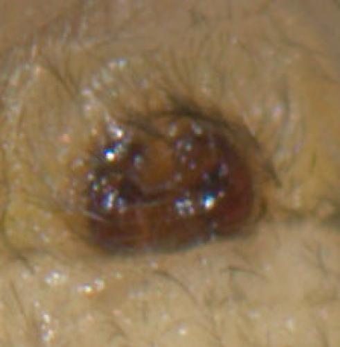 Cheiracanthium mildei
